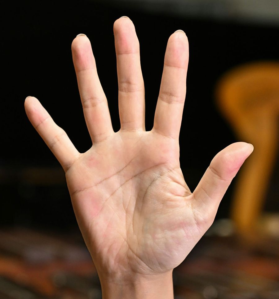 指導後の山下恵理さんの右手。マレットの跡がくっきり（写真はいずれも高知市神田）